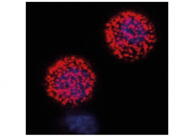 Brněn&scaron;t&iacute; hematologov&eacute; d&iacute;ky nejnověj&scaron;&iacute;m metod&aacute;m l&eacute;pe rozpoznaj&iacute; rakovinu krve